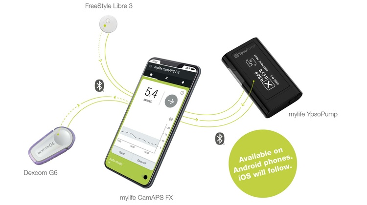 Primjer CGM uređaja i inzulinske pumpe